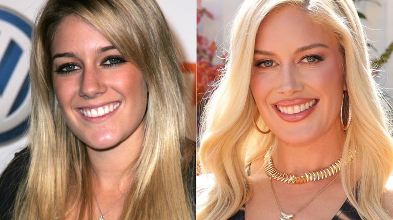 Heidi Montag before and after nose job
