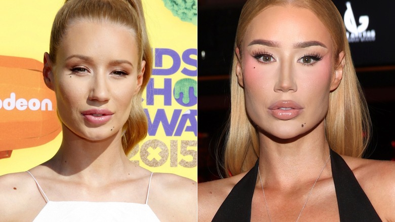 Iggy Azalea before and after nose job