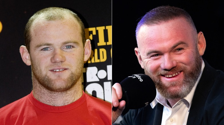 Footballer Wayne Rooney before his hair transplant and after