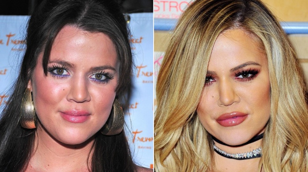 Khloe Kardashian before surgery; Khloe Kardashian after surgery