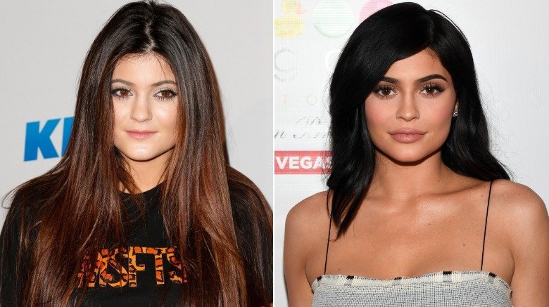 Kylie Jenner before and after lip fillers