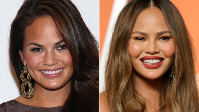 Chrissy Teigen's teeth before and after image