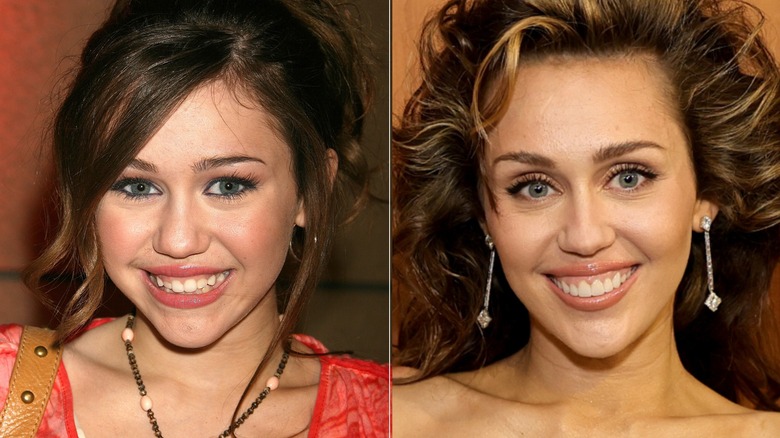 Miley Cyrus's teeth before and after split image