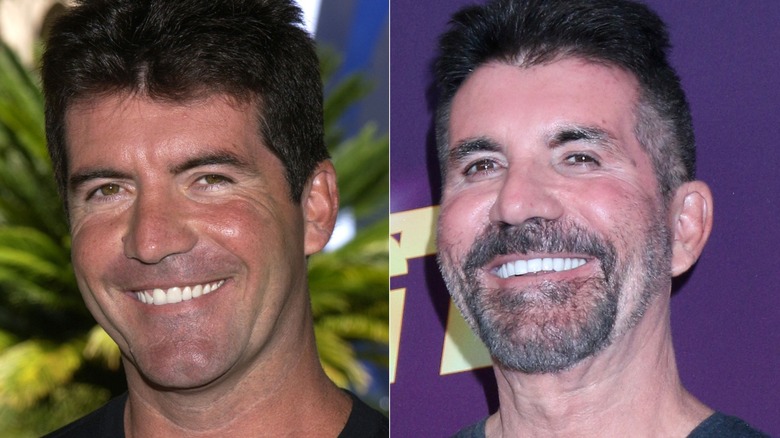 Simon Cowell's teeth before and after split image