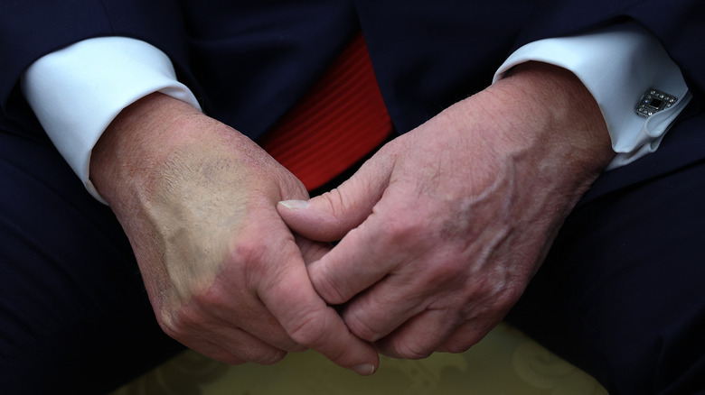 Close up of Donald Trump's bruised hand during meeting with President Nayib Bukele of El Salvador