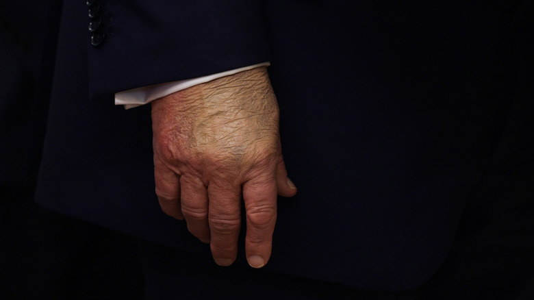 Close up of Donald Trump's hand and concealed bruise in September 2025