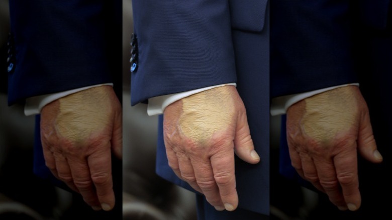 Close up of Donald Trump's hand during meeting with Gianni Infantino in August 2025