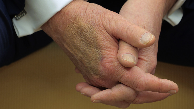 Close up of Donald Trump's clasped hands shows bruise in February 2025