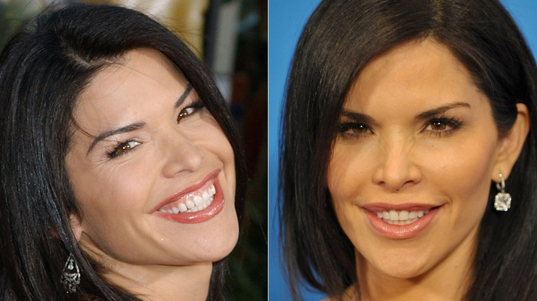 Lauren Sanchez smiling at red carpet events before and after work on her teeth
