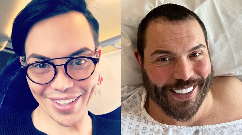 Split image of Bobby Norris smiling and smiling with a beard post-op