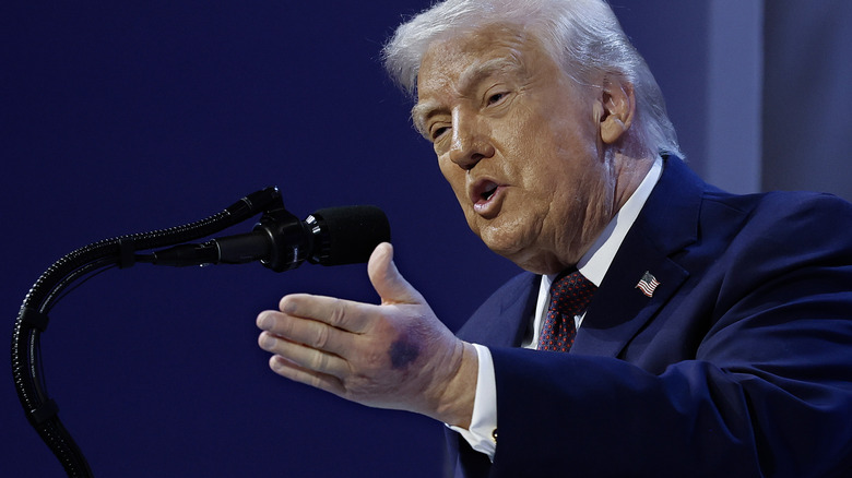 Donald Trump gesticulates in Davos, showing his bruised hand