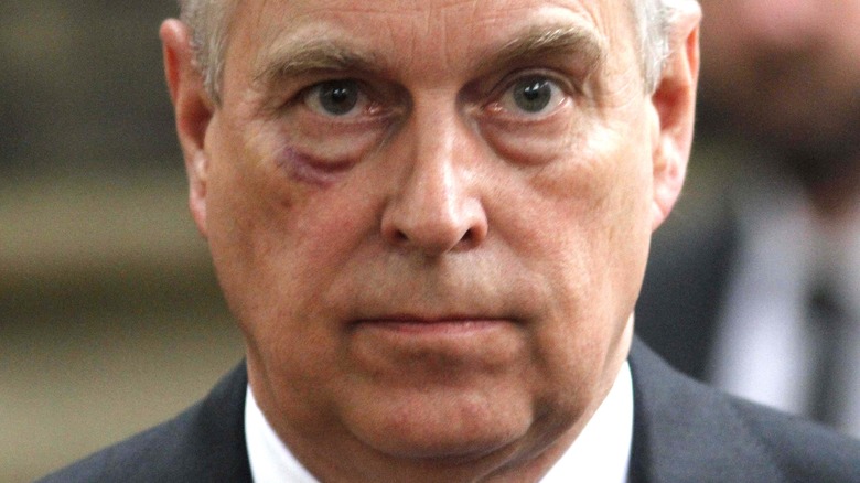 Prince Andrew with black eye