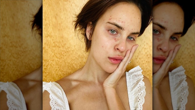 Tallulah Willis shows skin lesions