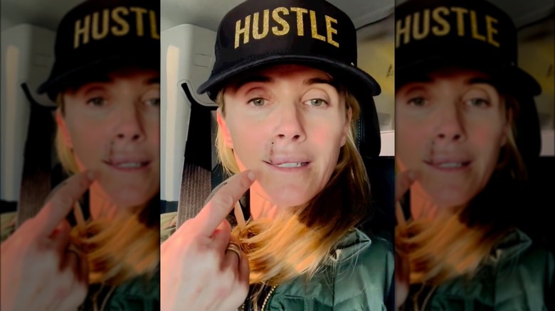 Jennifer Siebel Newsom shows a scar from her skin cancer removal surgery