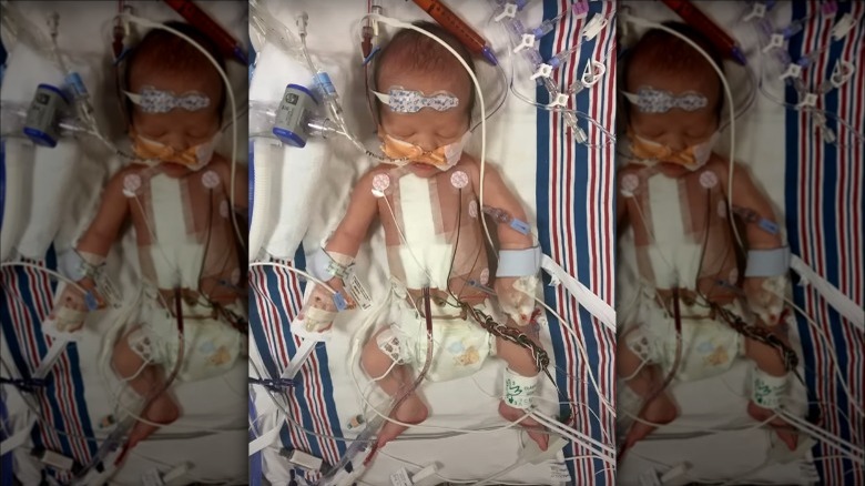 Baby Billy Kimmel with tubes