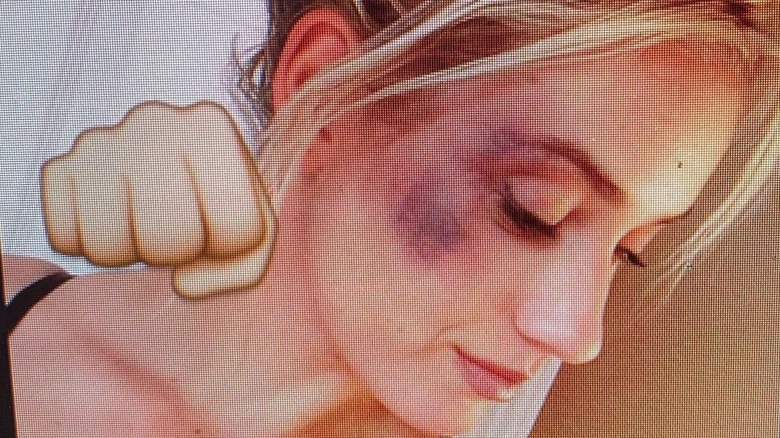 Paige Spiranac black eye 