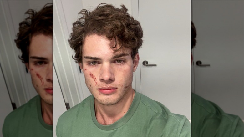 Clavicular selfie on X after being released from the hospital for an alleged overdose
