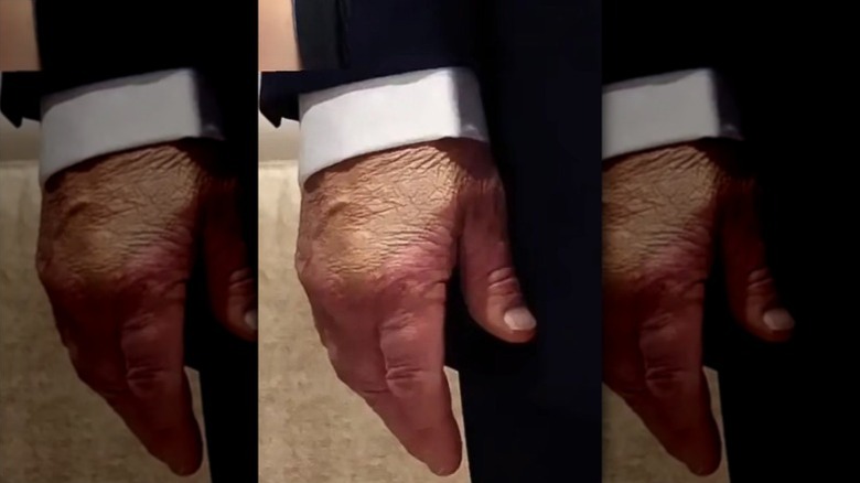 A closeup view of Donald Trump's hand