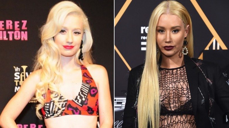 Iggy Azalea before and after plastic surgery