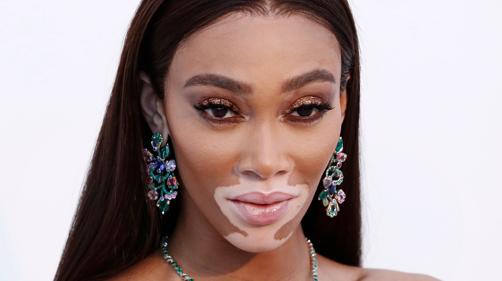 What You Need To Know About Winnie Harlow's Skin Condition