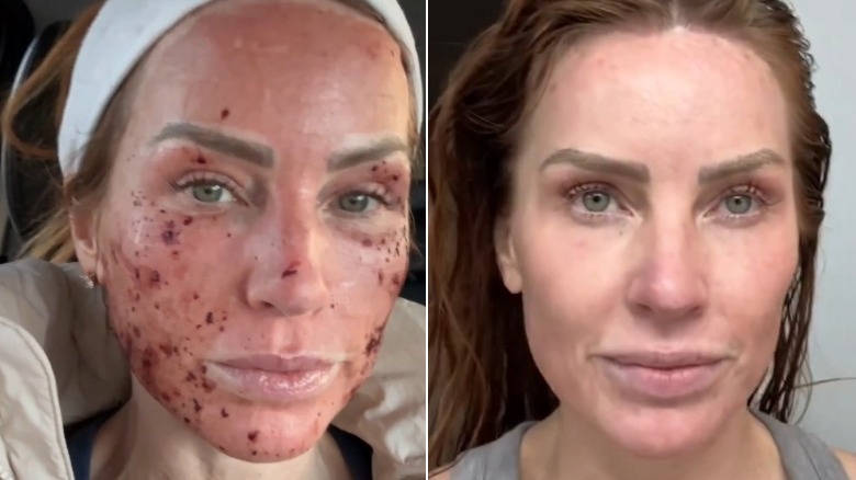 Split image of Mina Starsiak Hawk's face right after a laser treatment and eight days later.